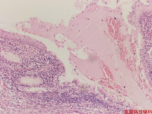 Cervical erosion with squamous metaplasia , Uterine cervix