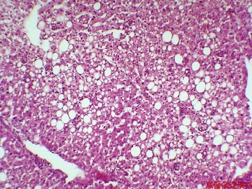 fatty liver histology