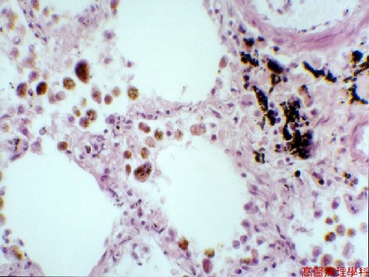 KMU Pathology Lab Slide 26 Heart Failure Cell Lung