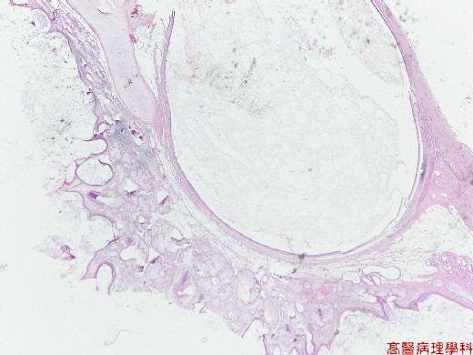 Ruptured Ovarian Cyst. Ruptured Ovarian Cyst Fluid