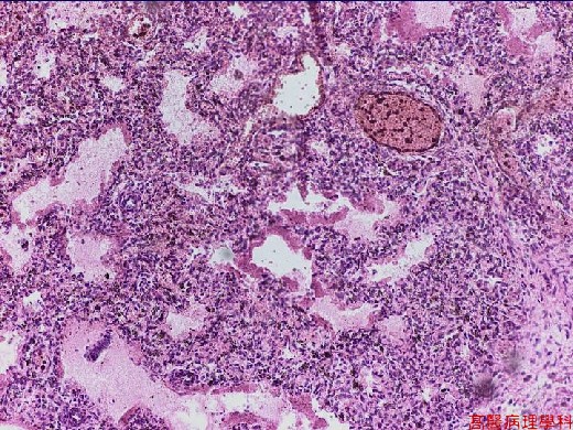 Kmu Pathology Labslide Hyaline Membrane Disease Lung