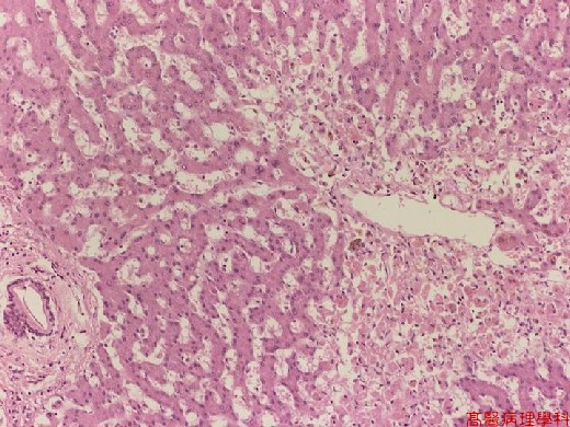 coagulative necrosis liver